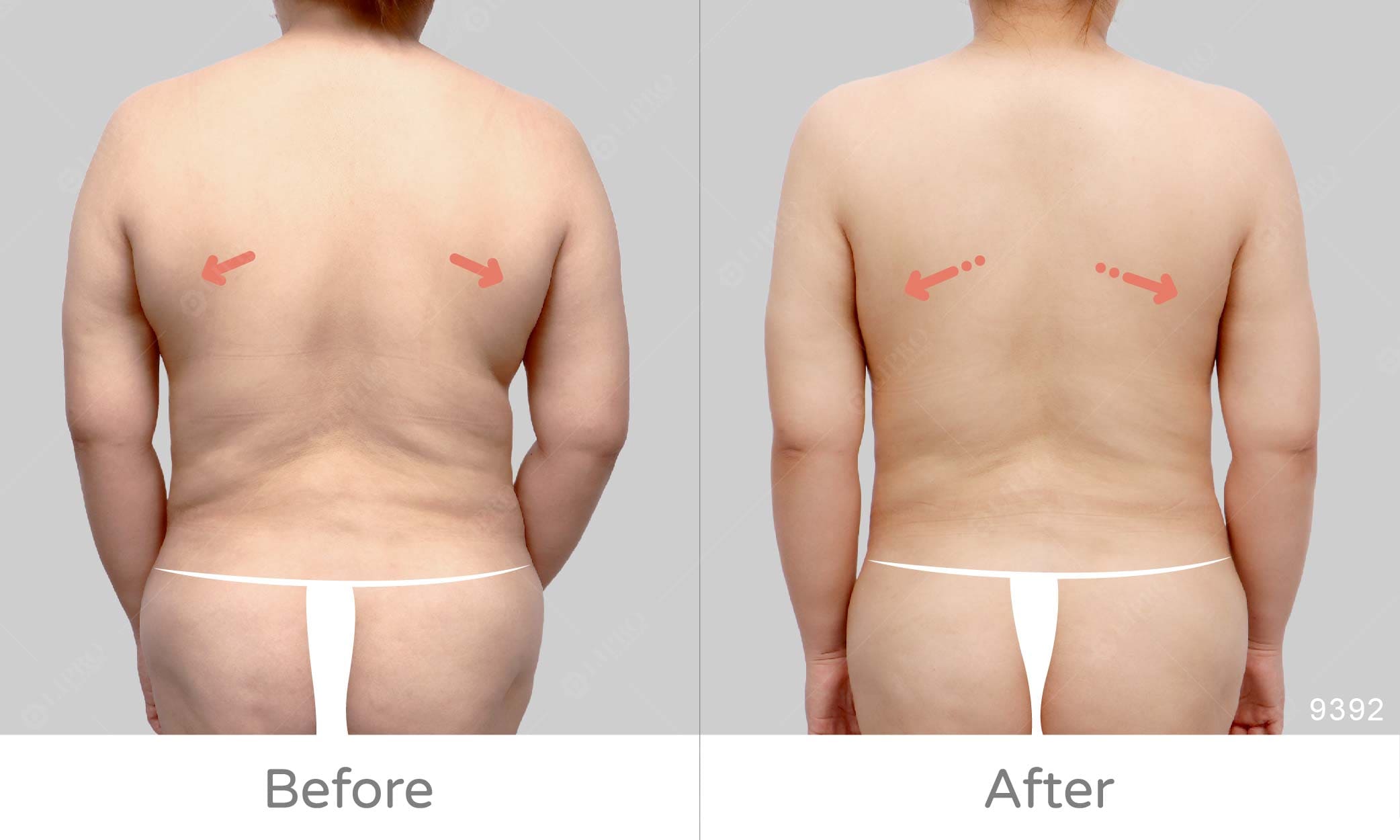 副乳抽脂案例術後術前比對，顯微套管抽脂修飾手臂副乳及後背的整體曲線