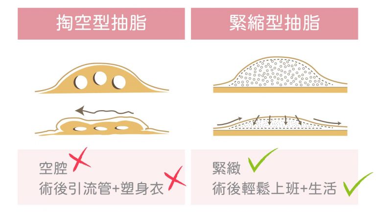 顯微套管抽脂術對組織傷害小，緊緻型抽脂方式讓皮膚自然回彈，不須穿塑身衣