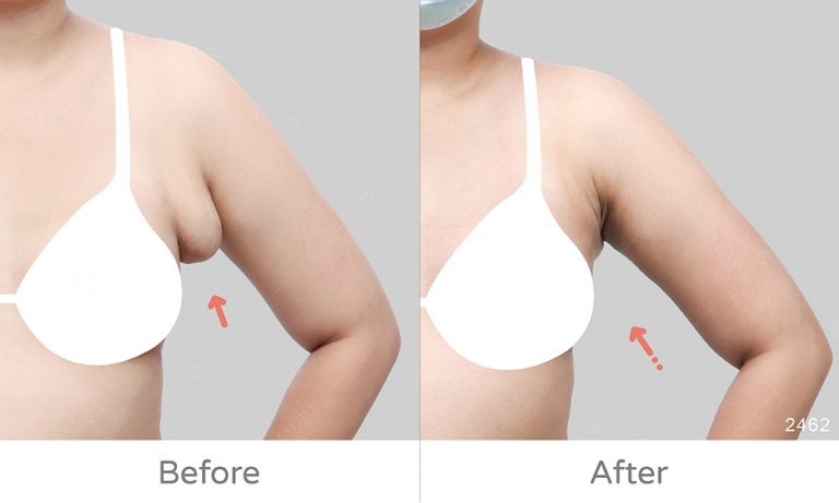 副乳修復，精緻抽脂首選麗波，顯微套管抽脂術不須穿塑身衣