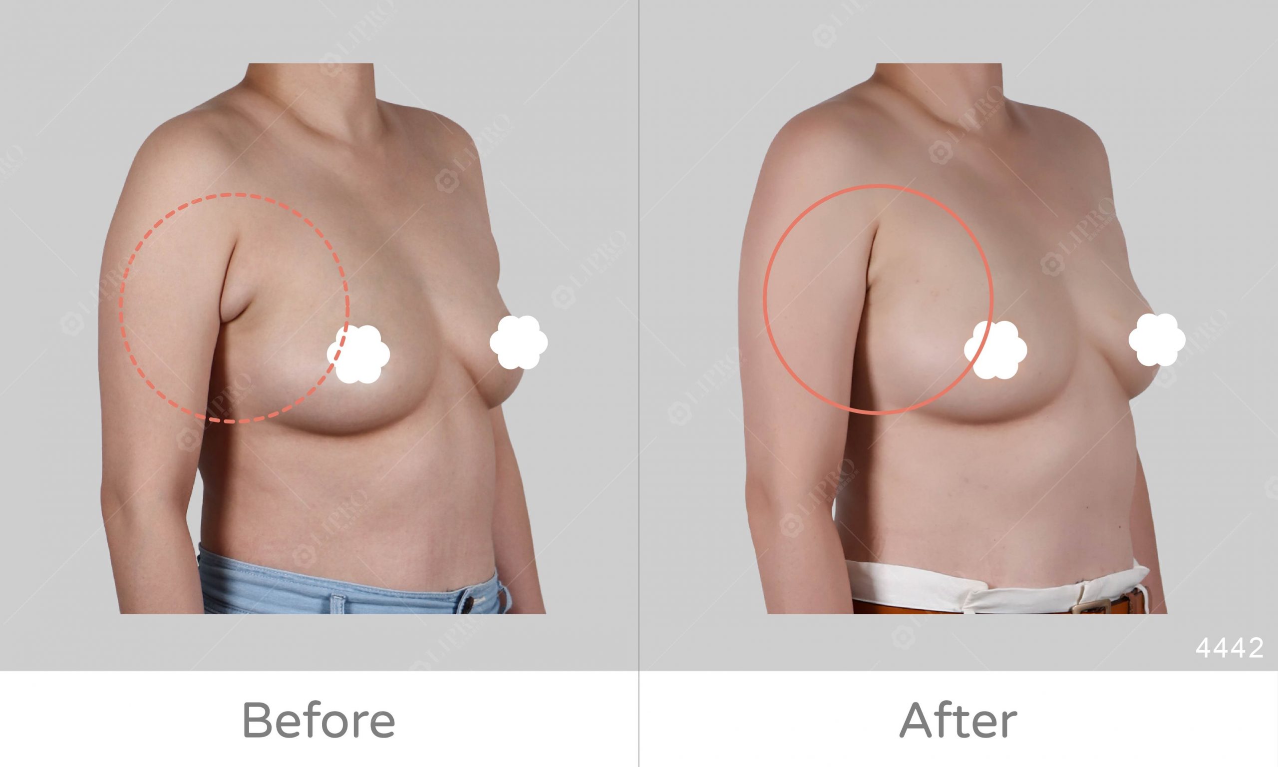 副乳手術對比、豐富副乳案例經驗，顯微套管副乳抽脂優勢