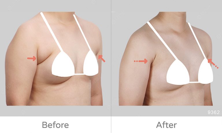 巨大副乳案例分享，擺脫副乳困擾大滿意，顯微套管抽脂特色