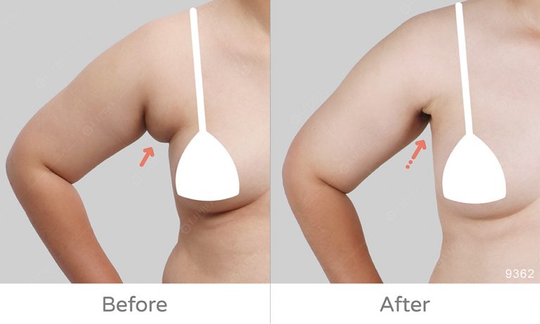 術後成效副乳案例，巨大副乳案例分享，顯微套管抽脂特色一:不須穿塑身衣