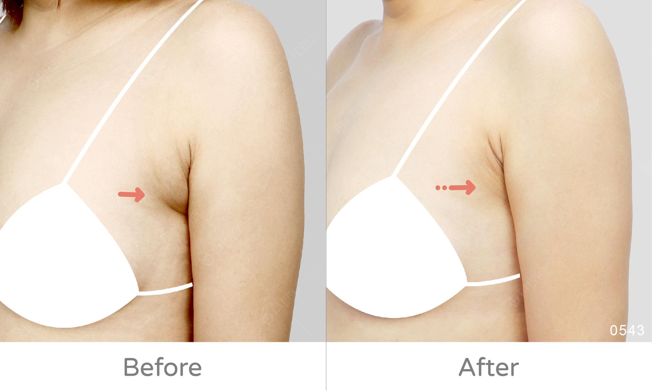 二次重修副乳案例，顯微套管抽脂術後成果圖，重修手術專家