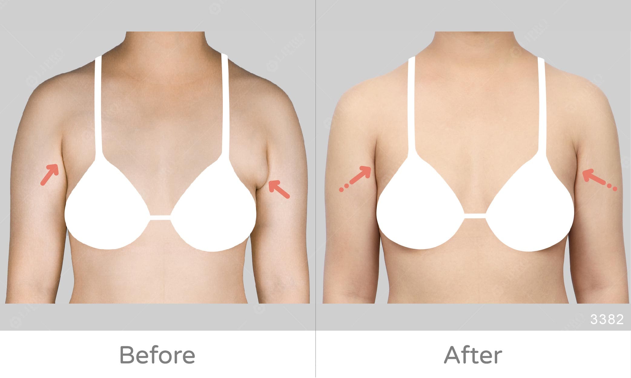副乳困擾案例成果，顯微套管抽脂可選擇清醒手術，術後恢復快速
