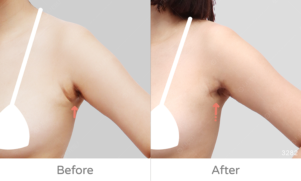 重修副乳案例效果展示圖，不須穿塑身衣、可清醒手術的抽脂方式