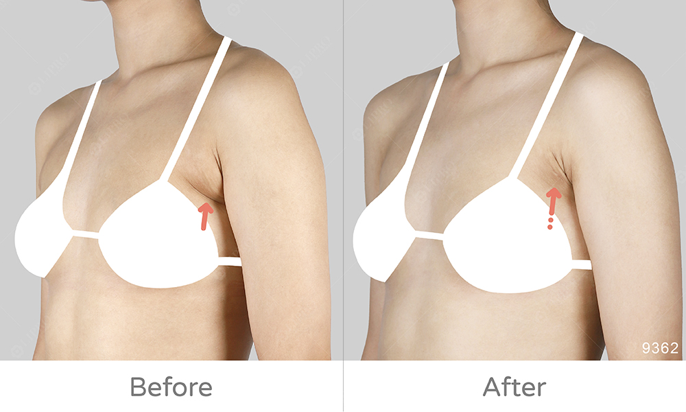 副乳案例類型A:三角形的副乳，麗波永康副乳案例經驗豐富