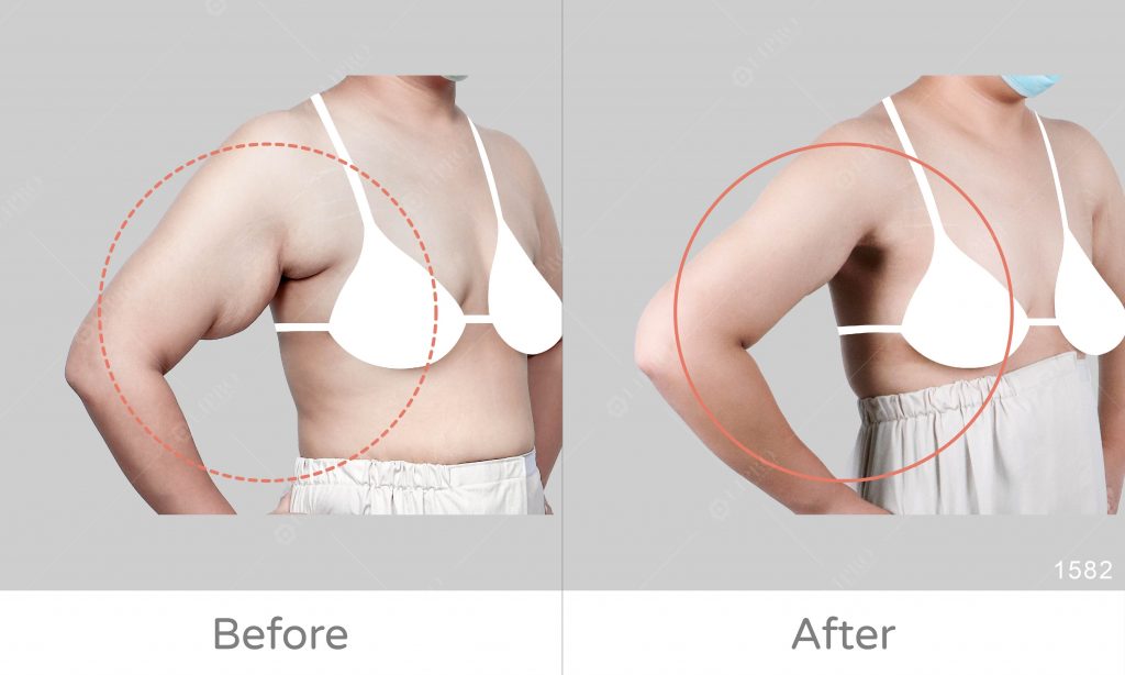 腋下鬆弛副乳利用顯微套管抽脂術，術後緊緻回縮，傷口極小且恢復快速，不須塑身衣