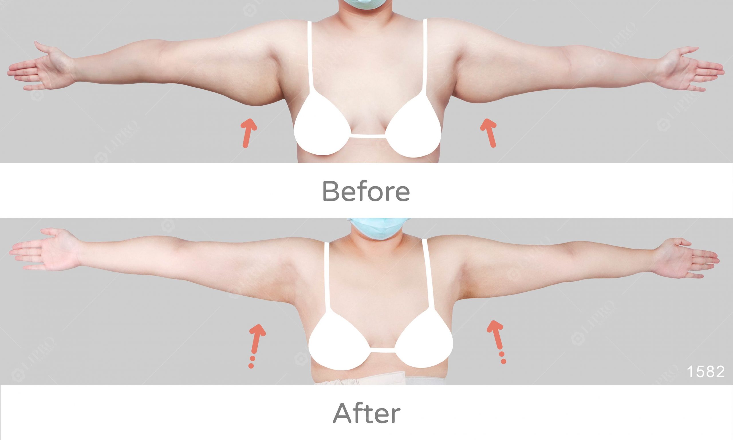 腋下鬆弛型副乳，不須塑身衣不須切皮，麗波手臂副乳案例分享