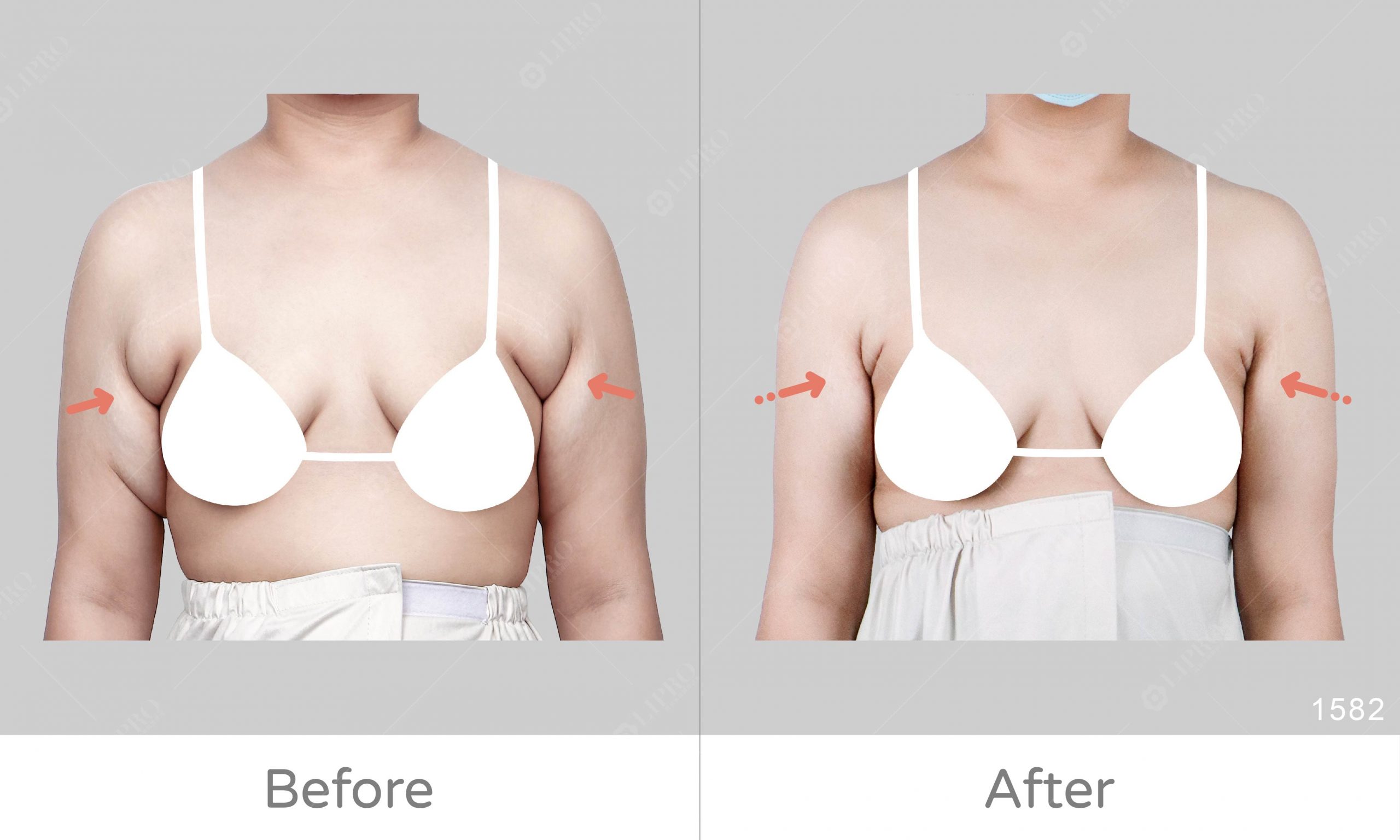 嚴重副乳案例、胖過再瘦，副乳案例見證抽脂手術前後對比