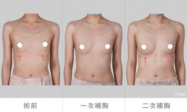 豐胸案例、自體脂肪移植成效見證，自體豐胸手術