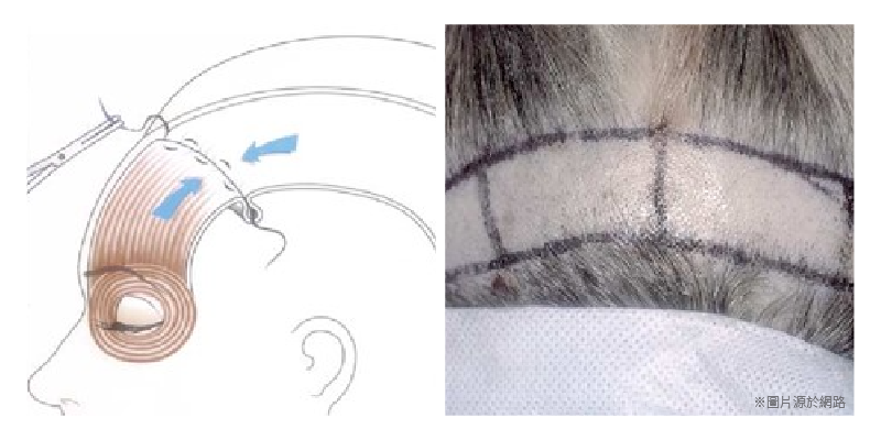 麗波永康提眉大眼手術與傳統前額拉皮手術的差異性，圖為傳統前額拉皮示意圖