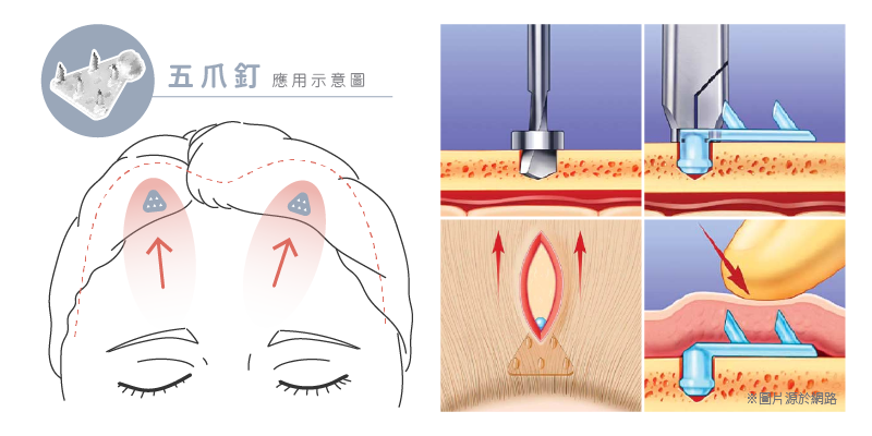 麗波永康提眉大眼手術與傳統五爪拉皮手術的差異性，圖為五爪拉皮示意圖