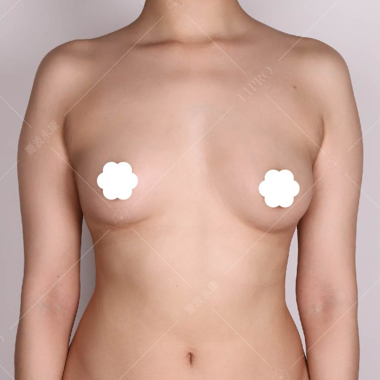 普遍來說，自體脂肪豐胸術後1個月，胸部會達到穩定的大小