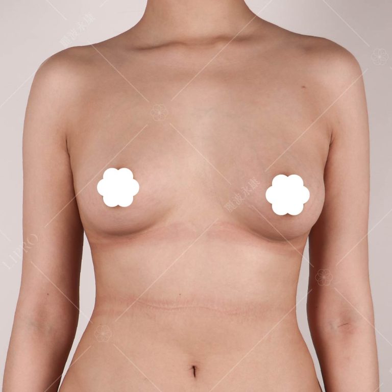附上麗波永康曾執行的自體脂肪隆乳案例圖提供參考