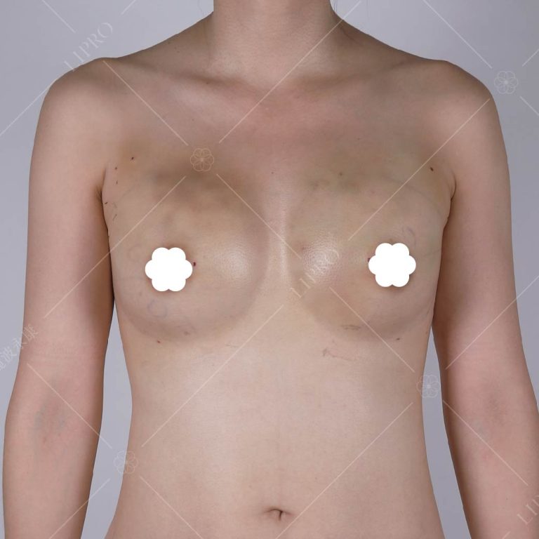手術後大約3天左右，胸部會有類似經期前脹奶的感覺