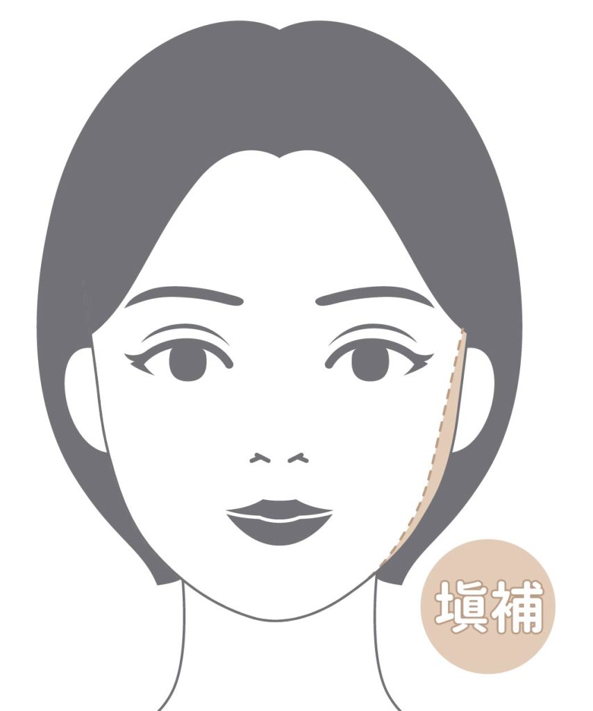 大部分女性會面臨左右臉不對稱的問題，可藉由麗波永康自體脂肪補臉技術填補脂肪缺失的地方