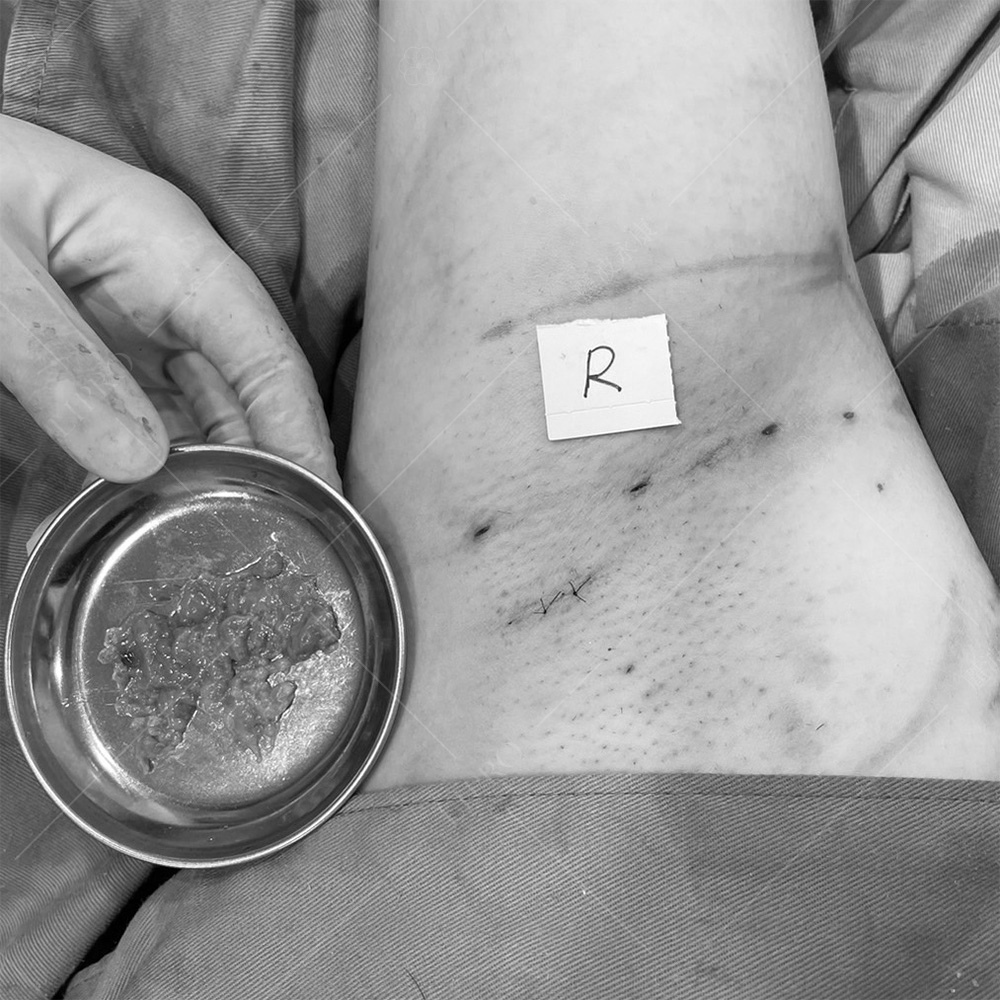 麗波永康顯微套管抽脂技術成熟，手術傷口極小並隱藏在皺褶處