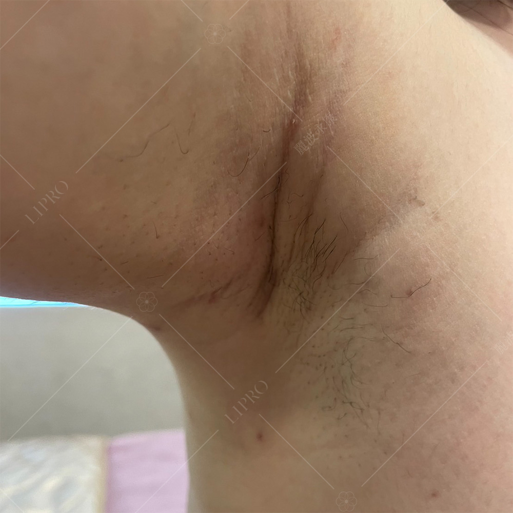 副乳抽脂術後第14天，右側腋下傷口恢復良好，幾乎看不出來