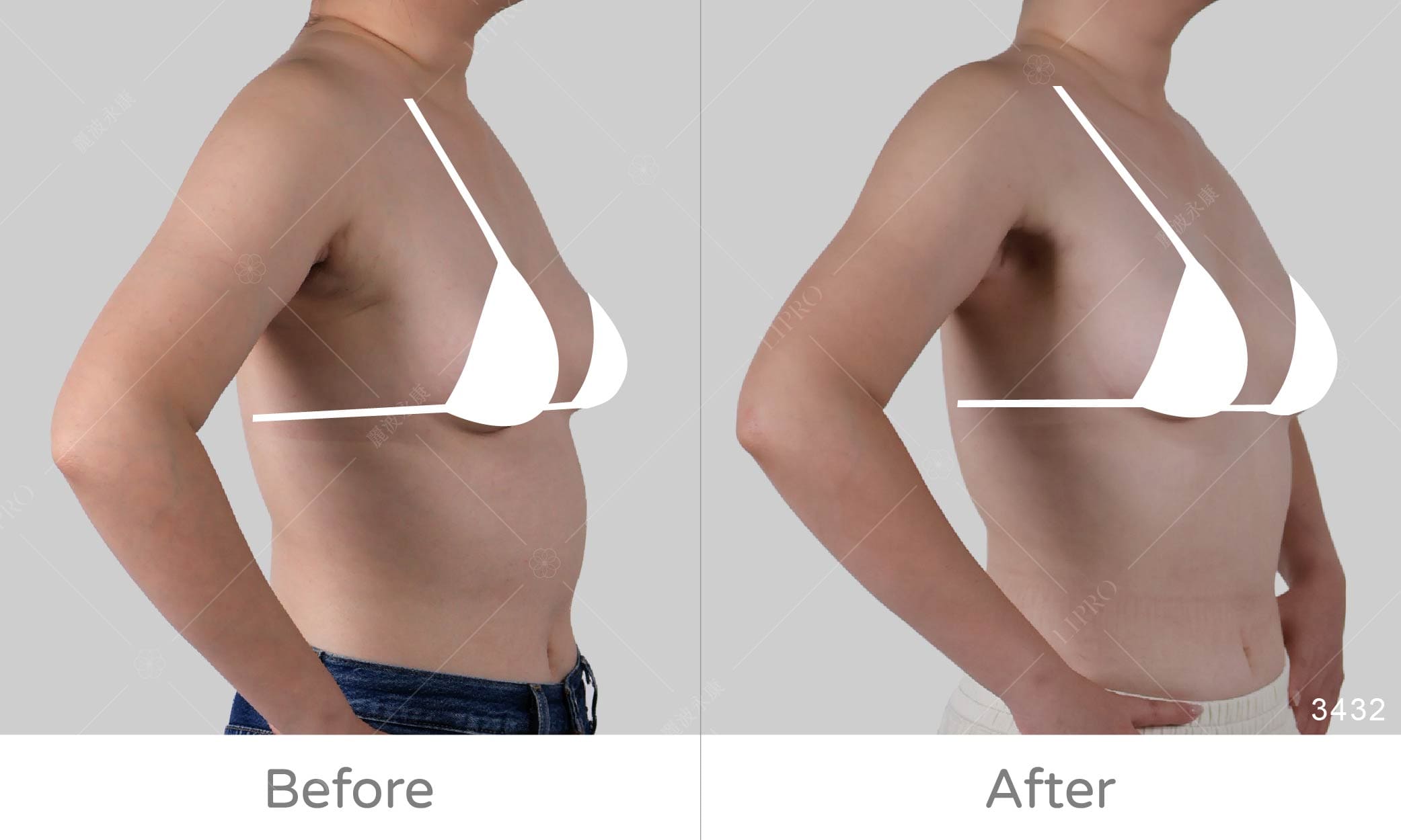 副乳抽脂手術術後狀況追蹤，左側手插腰45度角成效展示圖