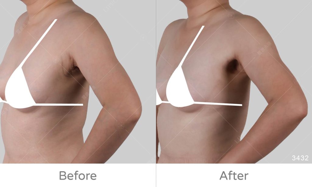 副乳抽脂手術術後狀況追蹤，右側手插腰45度角成效展示圖