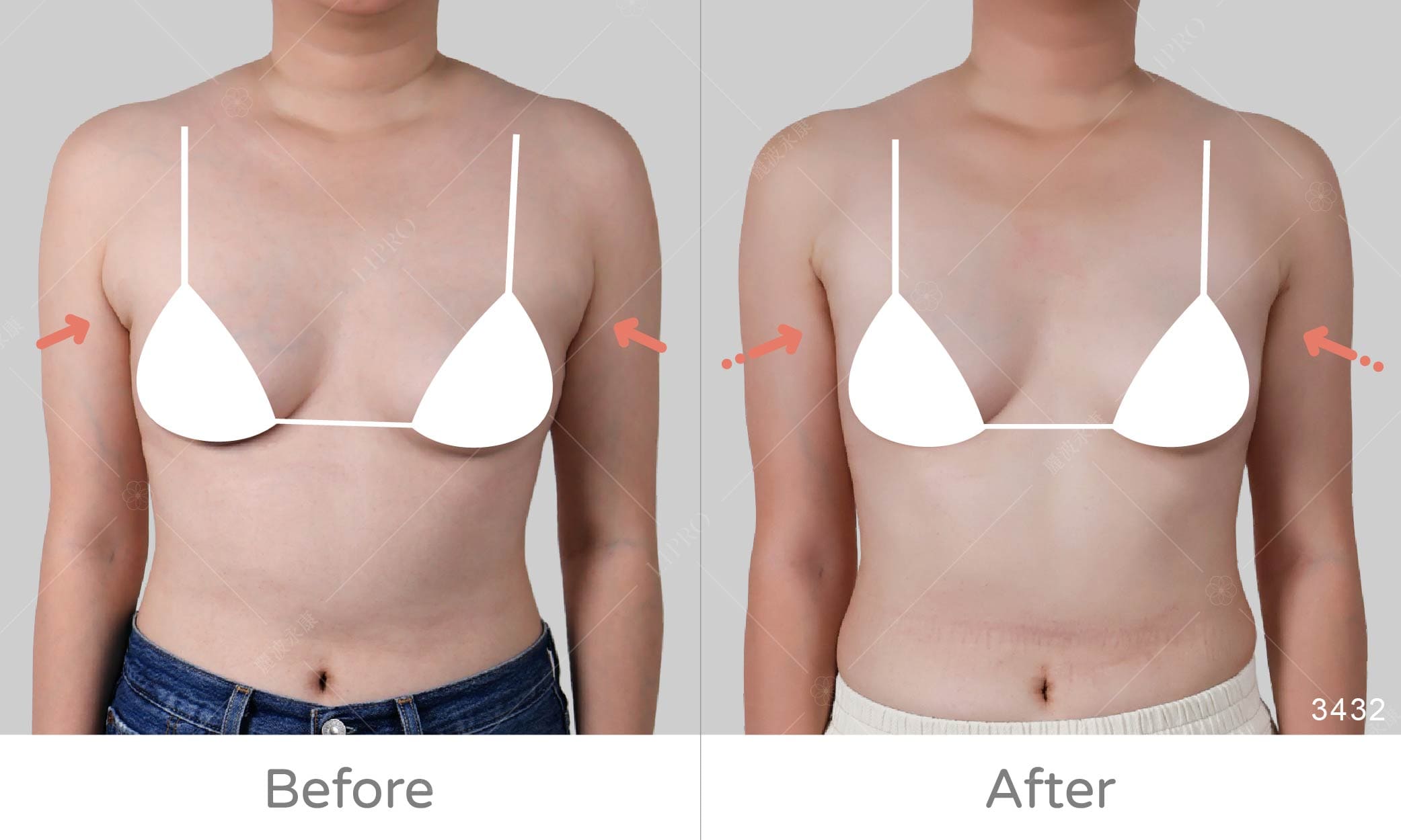 副乳抽脂手術術後效果定期紀錄，正面角度副乳抽脂成效展示圖