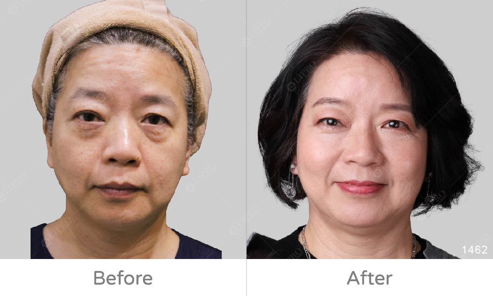 眼周補脂、臉部補脂案例分享，麗波自體脂肪移植