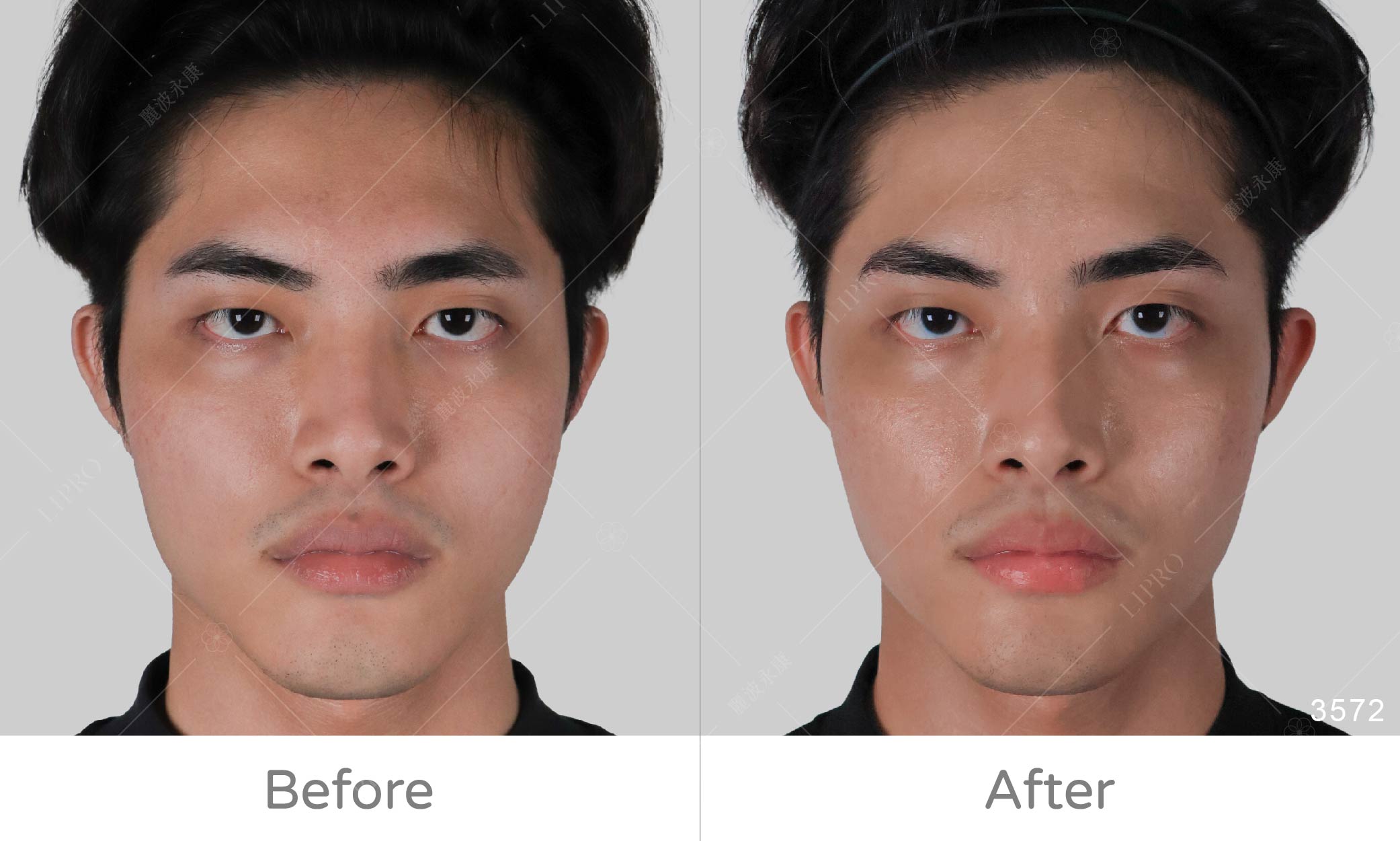 全臉補脂案豐富案例，顯微套管自體補臉術後成效正面角度效果