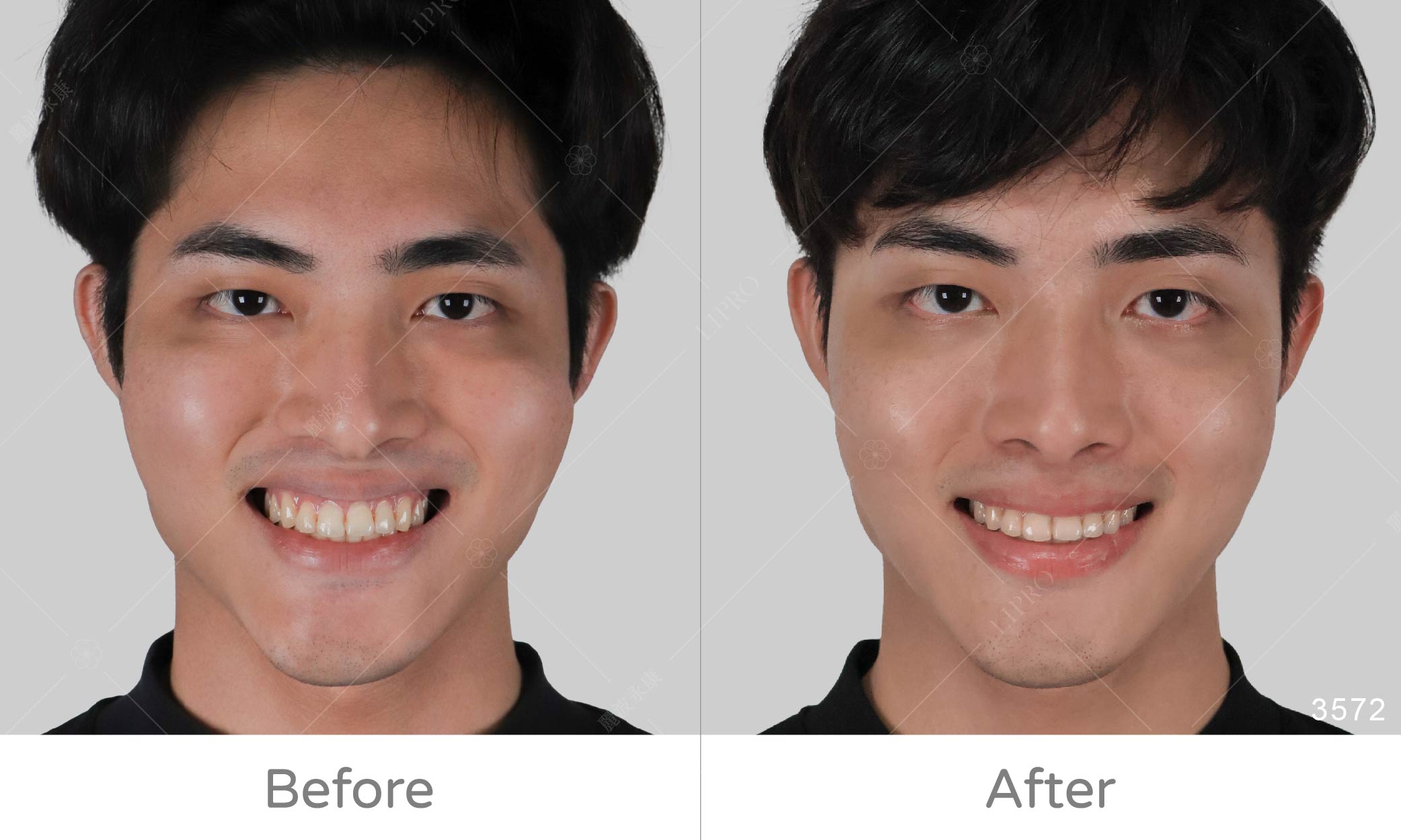 全臉補脂案豐富案例，顯微套管自體補臉術後成效正面角度微笑效果