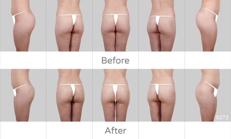 臀部補脂案例分享，五種角展示術後臀腿背面成效