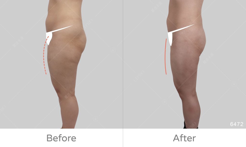 全腿美型抽脂案例見證，大腿前側線條修飾術後成效展示