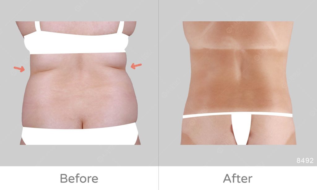 麗波永康腰腹抽脂案例評價，背面角度呈現顯微套管抽脂術後成效