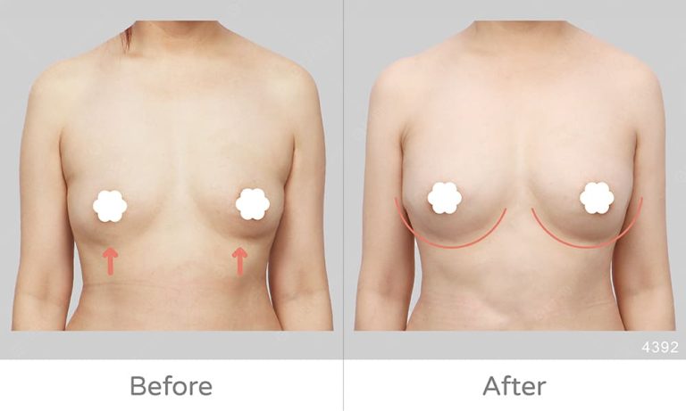 麗波永康豐胸評價、顯微套管自體脂肪豐胸案例，手術成效展示