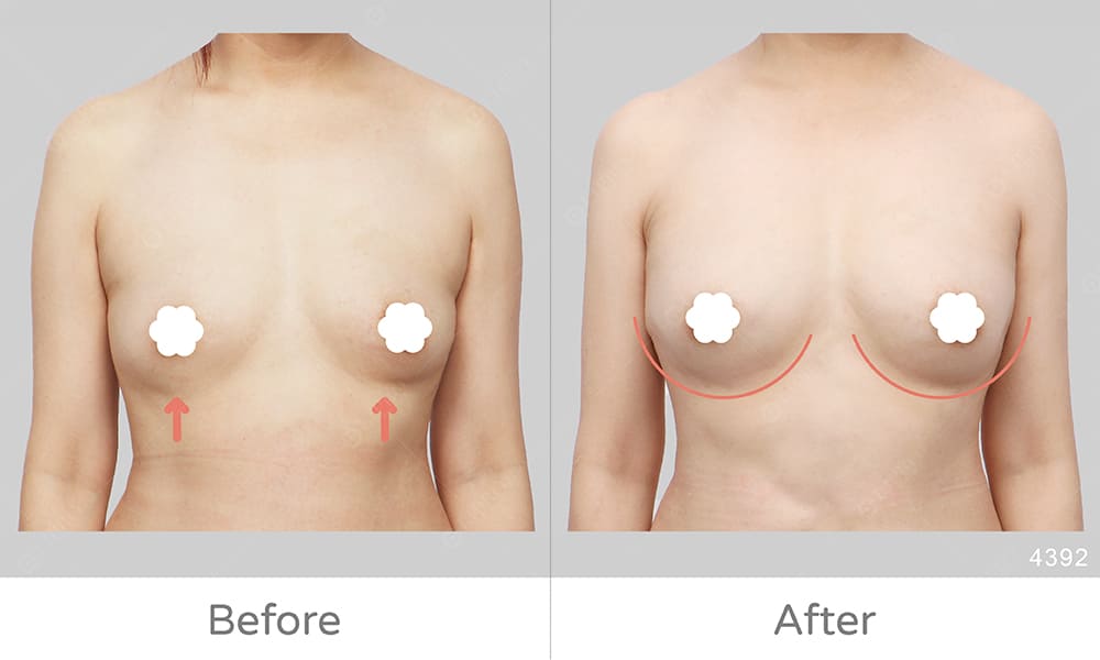 麗波永康豐胸評價、顯微套管自體脂肪豐胸案例，手術成效展示