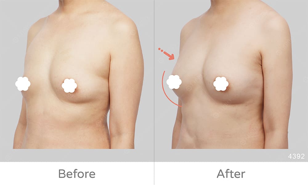自體豐胸手術成效展示，隆乳手術評價，隆乳手術推薦
