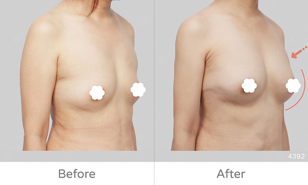 自體隆乳手術推薦、麗波永康國際診所自體脂肪隆豐胸豐富案例