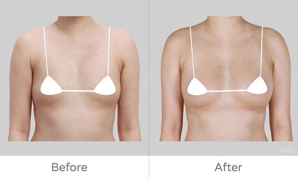 顯微套管抽脂豐胸案例、正面展示豐胸術後成效，麗波永康自體豐胸評價