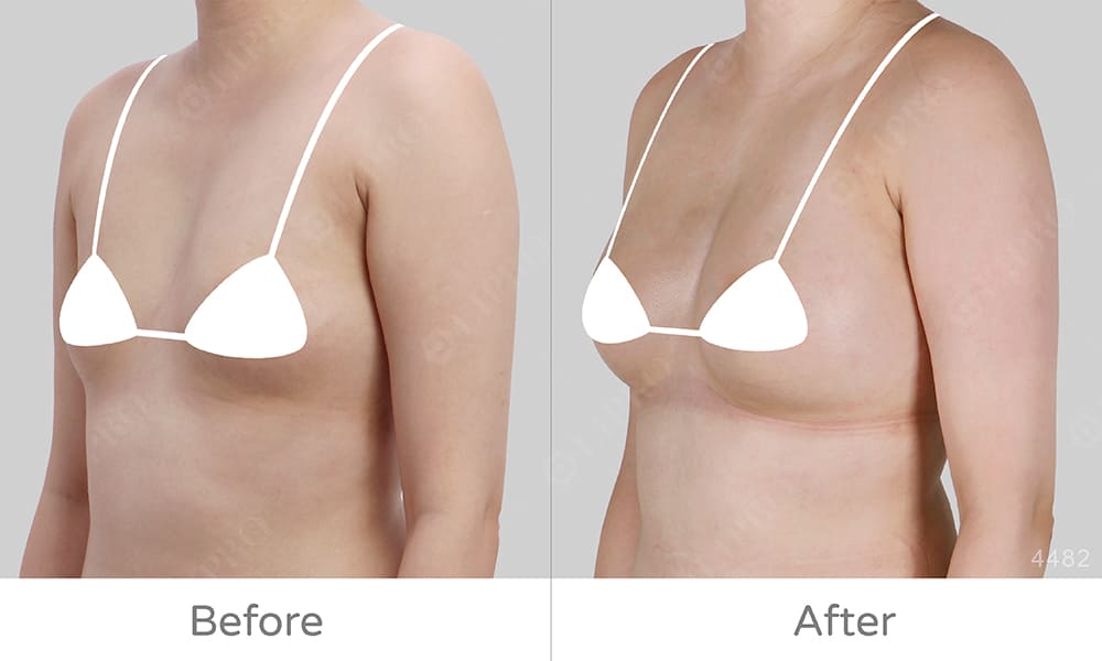 側面45度角展示豐胸術後成效，麗波永康自體豐胸好評見證