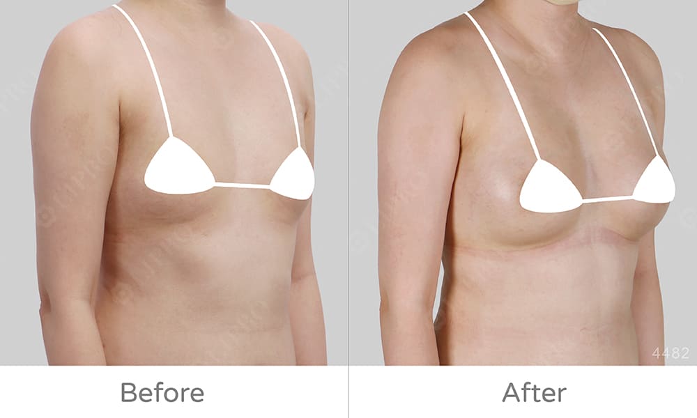 顯微套管自體脂肪隆乳案例分享，豐胸手術術後成效明顯