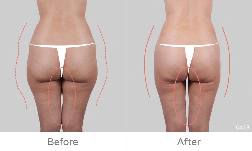 大腿內側外側曲線修飾、顯微套管抽脂術後恢復快速