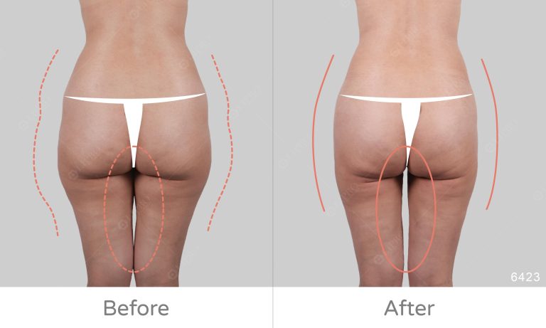 大腿內側外側曲線修飾、顯微套管抽脂術後恢復快速