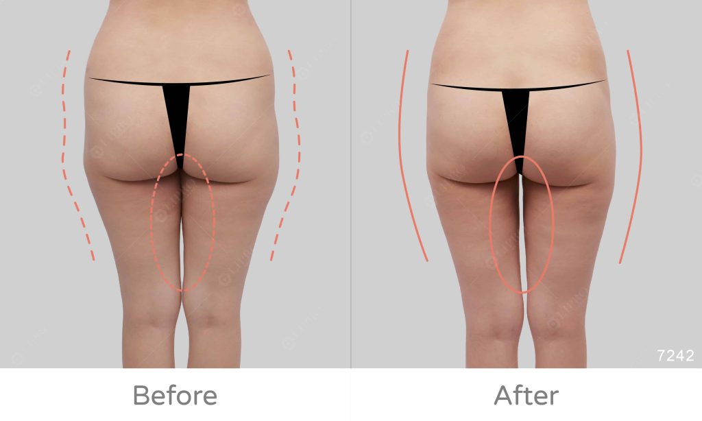 大腿內外側曲線修飾案例、術後不需穿塑身衣的抽脂選擇