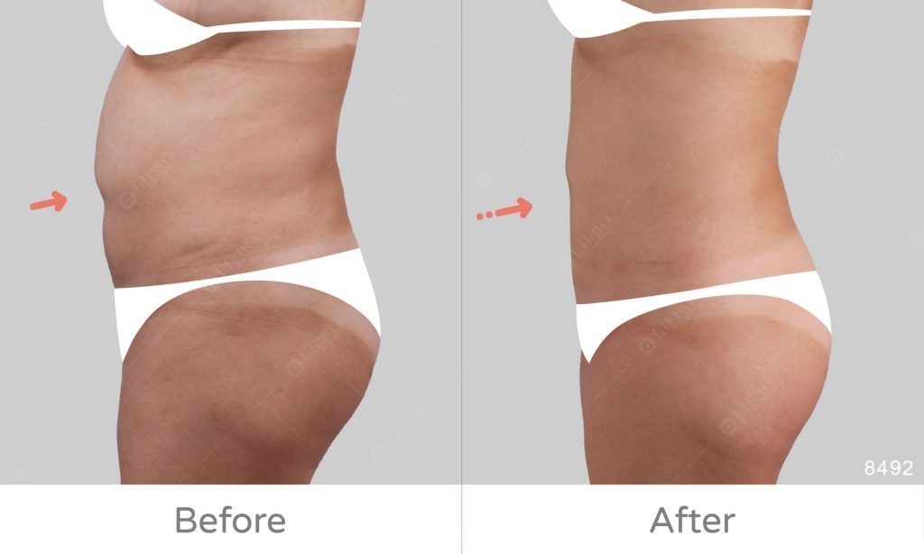 顯微套管二次修復上半身腰腹案例成果展示，減少腹部不規則凹凸感