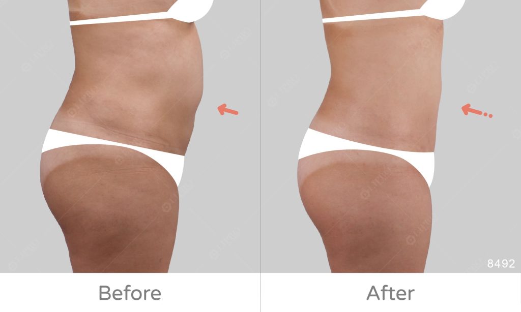 麗波永康腰腹重修抽脂案例，修復腹部不規則凹凸曲線