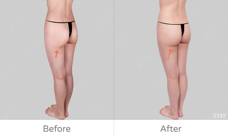 麗波永康國際診所臀部抽脂案例豐富、術後不需穿塑身衣的輕鬆抽脂方式