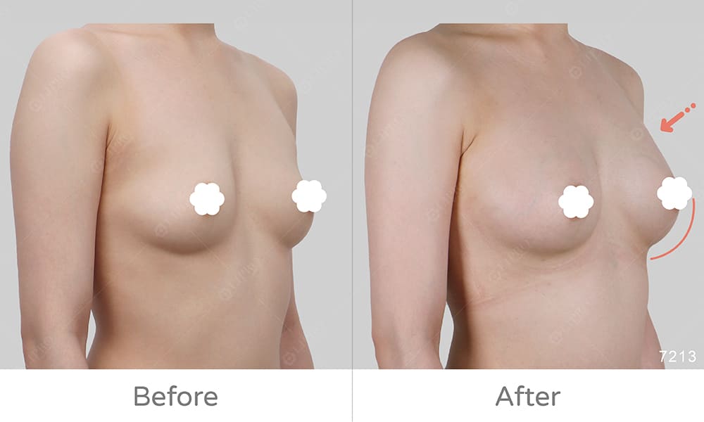 自體脂肪豐胸B罩杯案例，顯微套管手術前後成效展示圖