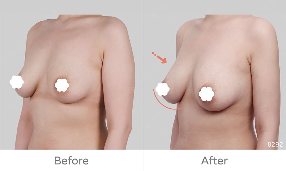 避免假體豐胸的副作用，可以選擇顯微套管自體脂肪豐胸手術