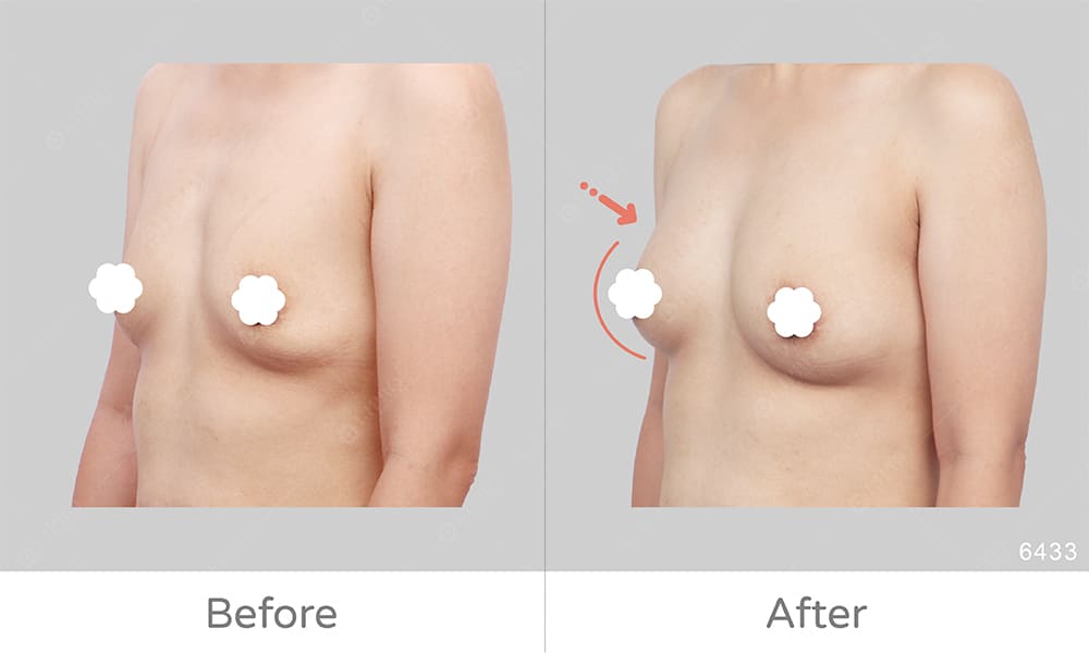 罩杯升級產後鬆弛案例豐胸手術術後成效對比圖
