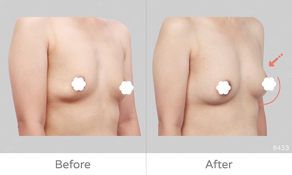 顯微套管自體豐胸罩杯產後鬆弛案例，麗波永康豐胸案例好評分享