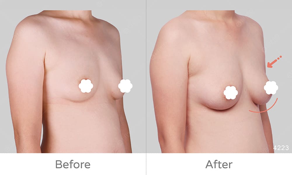 麗波永康自體豐胸案例好評見證，顯微套管抽脂技術術後免穿塑身衣