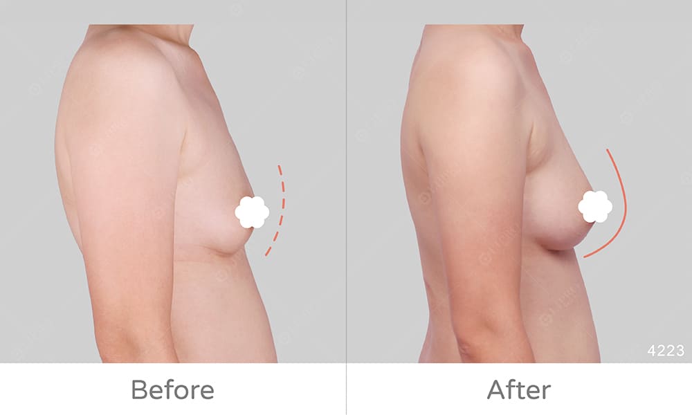 顯微套管抽脂技術術後免穿塑身衣、自體脂肪移植胸部自然無夾饃問題